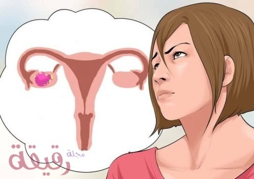 علاقة تكيس المبايض بالحمل