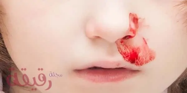 تفسير حلم نزيف من الأنف في المنام .. نزول الدم من الأنف في المنام تفسير حلم نزيف من الأنف في المنام .. نزول الدم من الأنف في المنام - مجلة رقيقة
