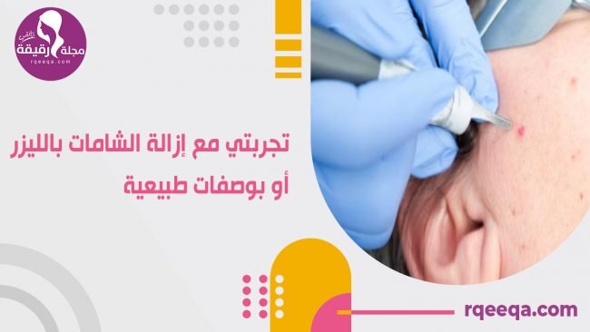 تجربتي مع إزالة الشامات بالليزر أو بوصفات طبيعية